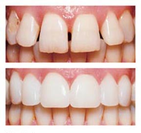 porcelain veneers ballarat